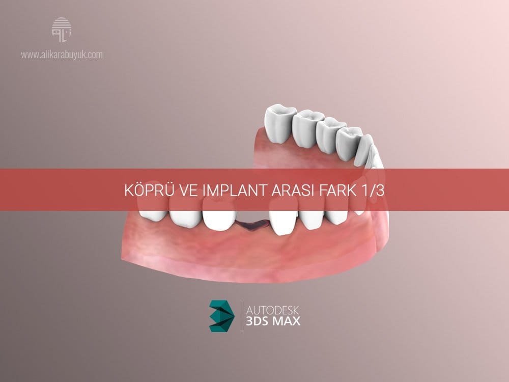 3D Implant ve Köprü Karşılaştırması 01 3D Implant ve Diş Karşılaştırması 01