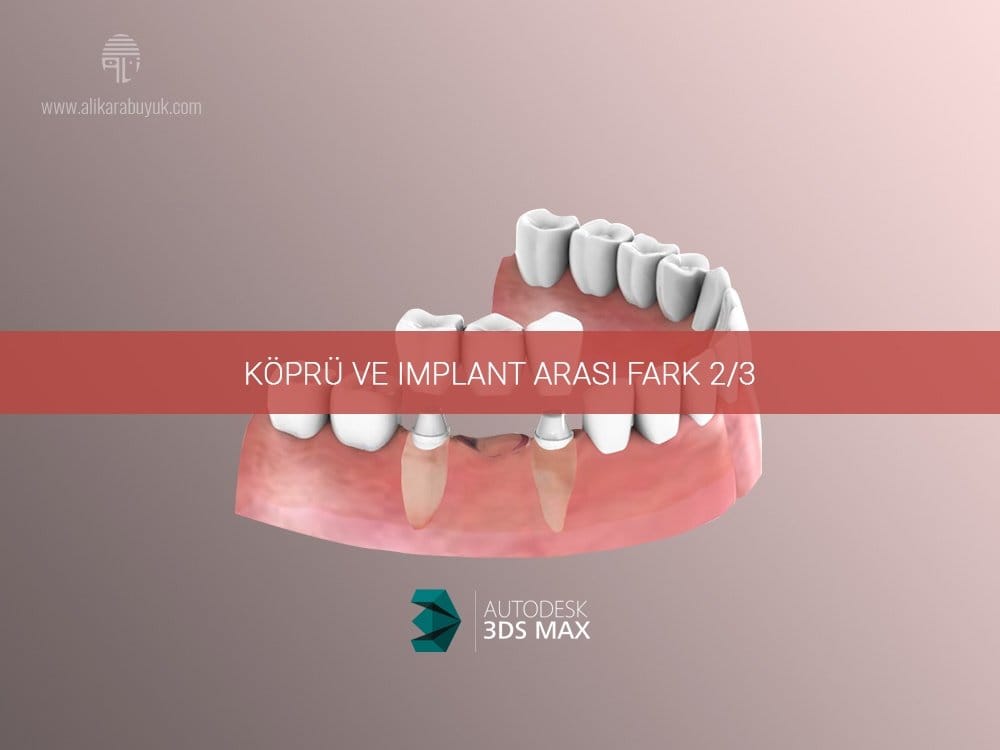 3D Implant 3D Implant ve Diş Karşılaştırması