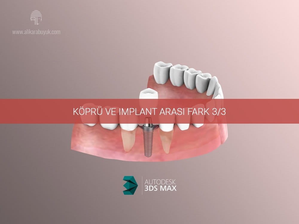 3D Implant ve Köprü Karşılaştırması 03 3D Implant ve Diş Karşılaştırması 03