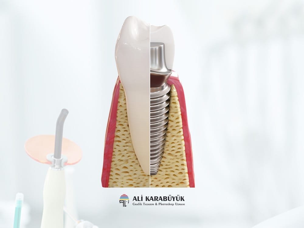 3D Implant Modelleme