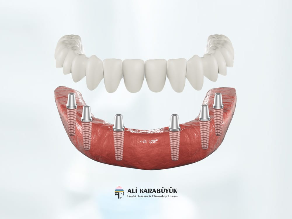 3d implant ve kopru karsilastirmasi