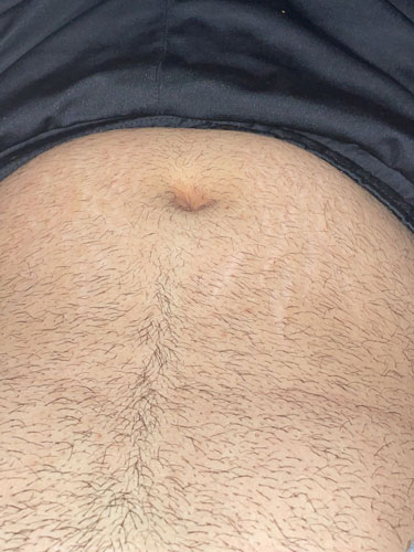 Dikiş efekti uygulanmadan önce, vücut üzerinde herhangi bir cerrahî dikiş bulunmayan görüntü