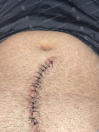 Vücut üzerine Photoshop ile eklenmiş gerçekçi cerrahî dikiş efekti